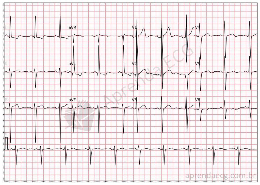Electrocardiogram showing left anterior fascicular block (LAFB)