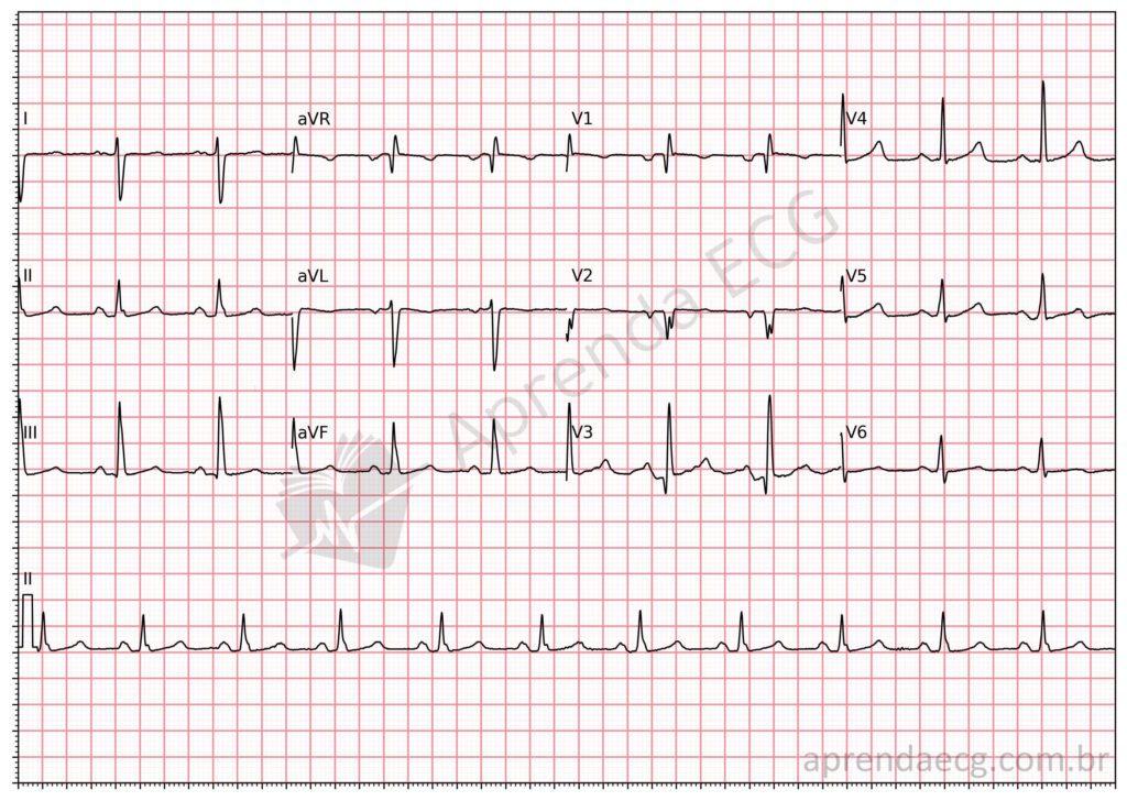 Electrocardiogram showing left posterior fascicular block (LPFB)