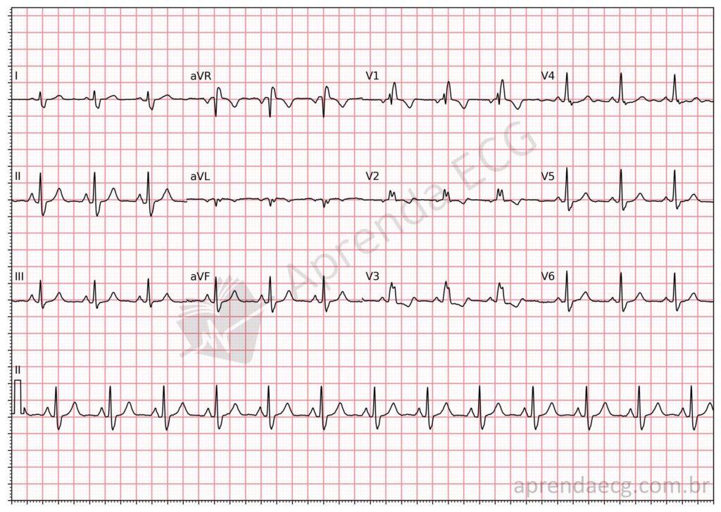 Electrocardiogram showing right bundle branch block