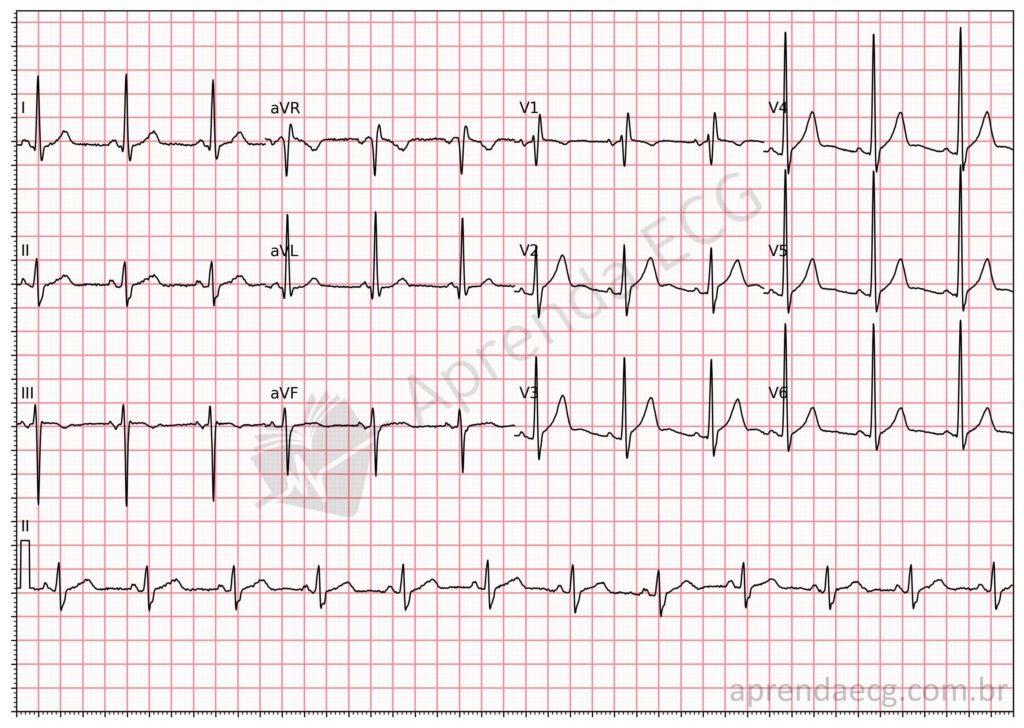 Electrocardiogram showing a right bundle branch conduction delay