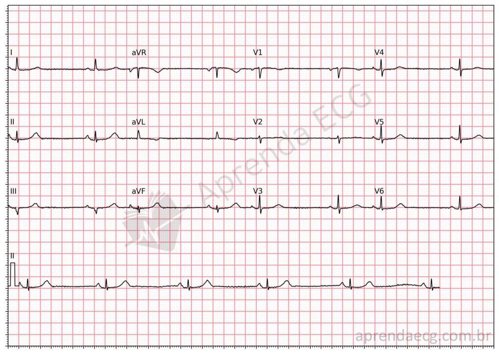 Electrocardiogram in hypothyroidism