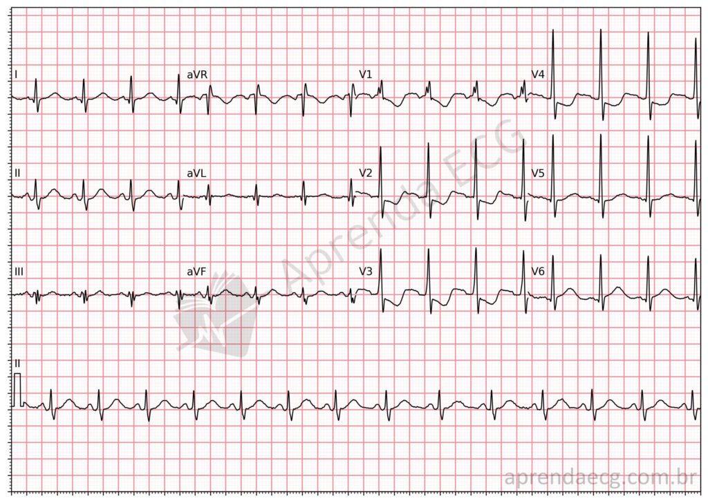Electrocardiogram showing ST depression from V1 to V3