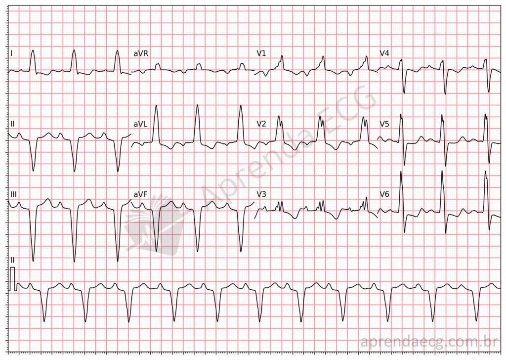 Electrocardiogram showing masquerading bundle branch block