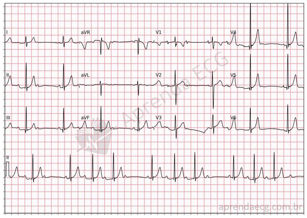 Electrocardiogram showing second-degree Mobitz 1 atrioventricular block