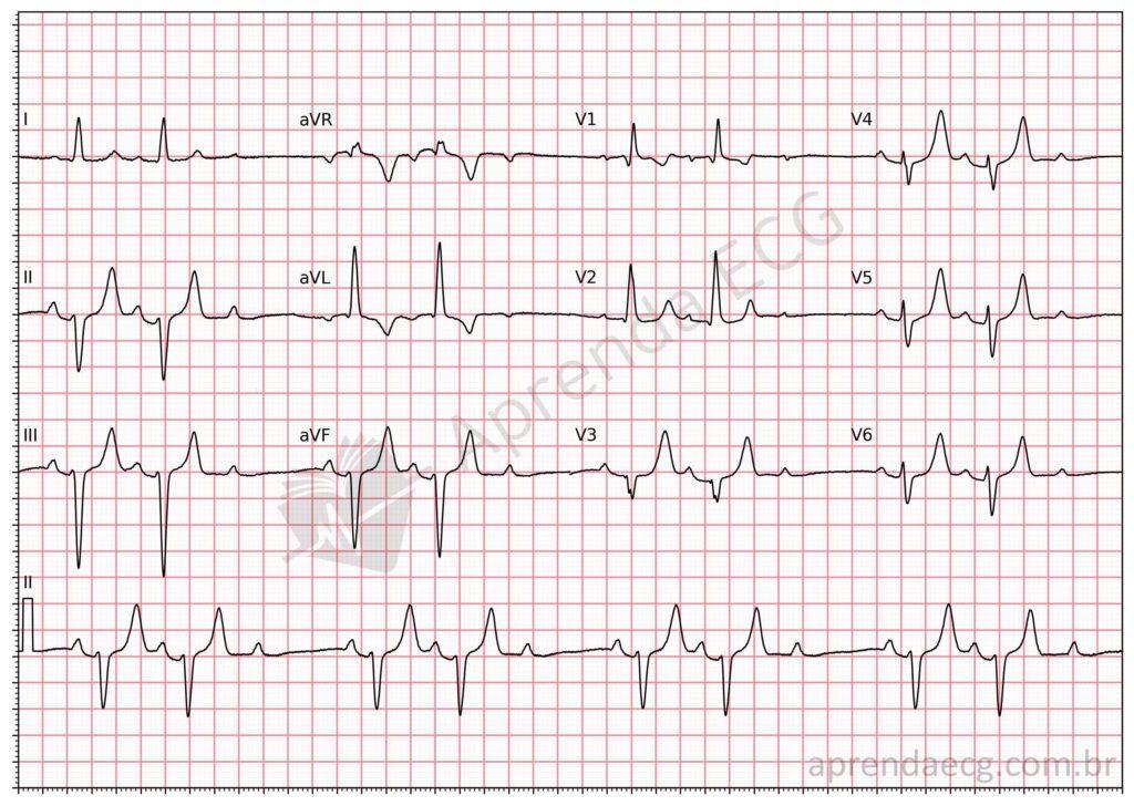 Electrocardiogram showing second-degree Mobitz 2 atrioventricular block