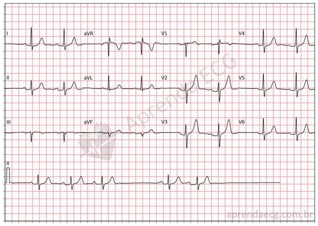 Electrocardiogram with sinus arrest