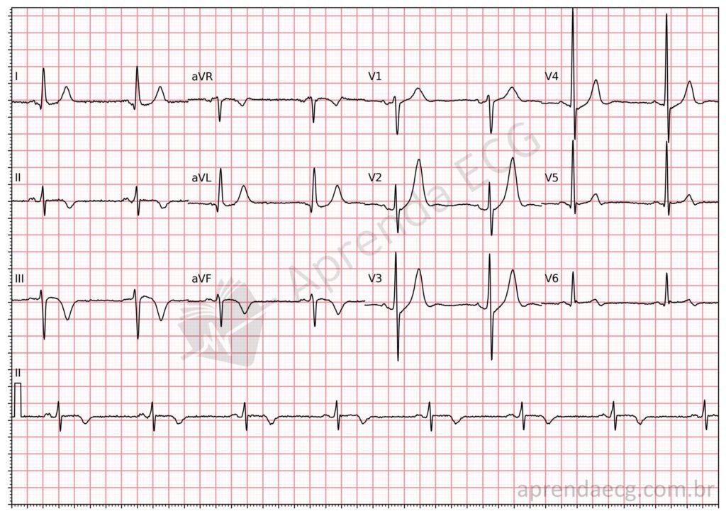 Electrocardiogram showing hyperacute T waves