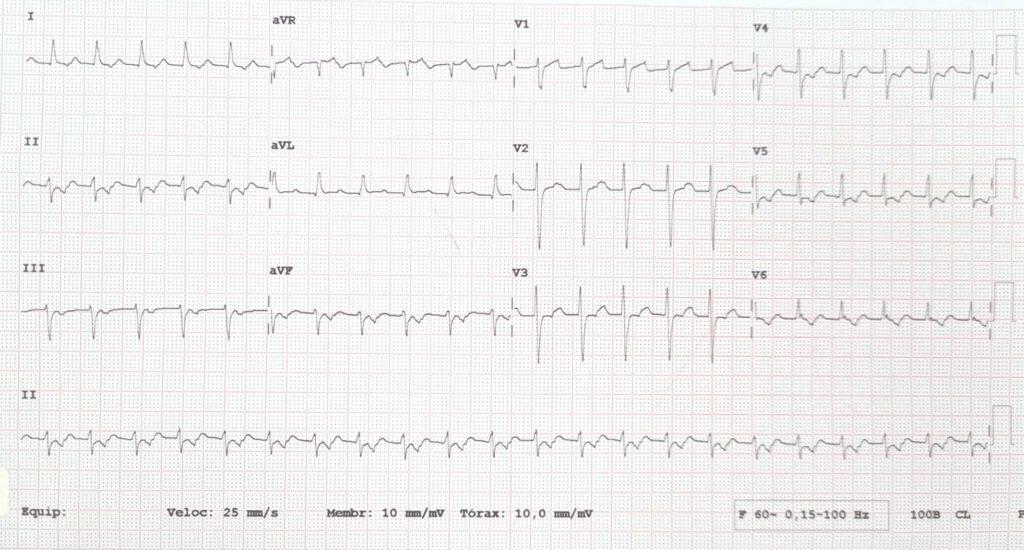 Electrocardiogram showing atrioventricular reentrant tachycardia