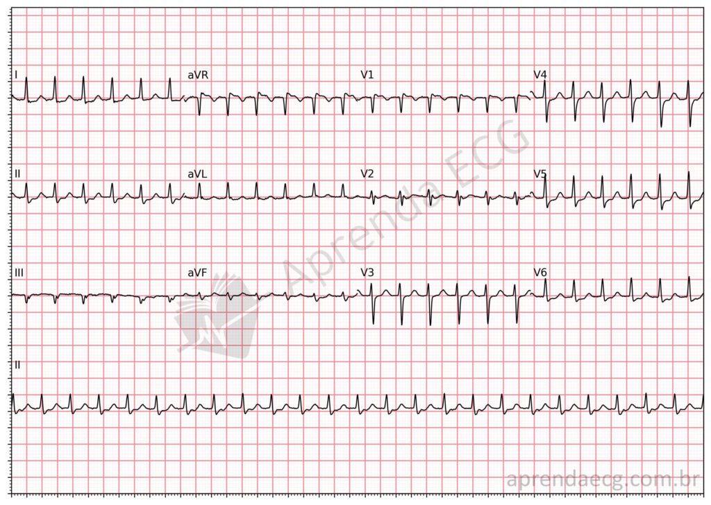 Electrocardiogram showing AV nodal reentrant tachycardia
