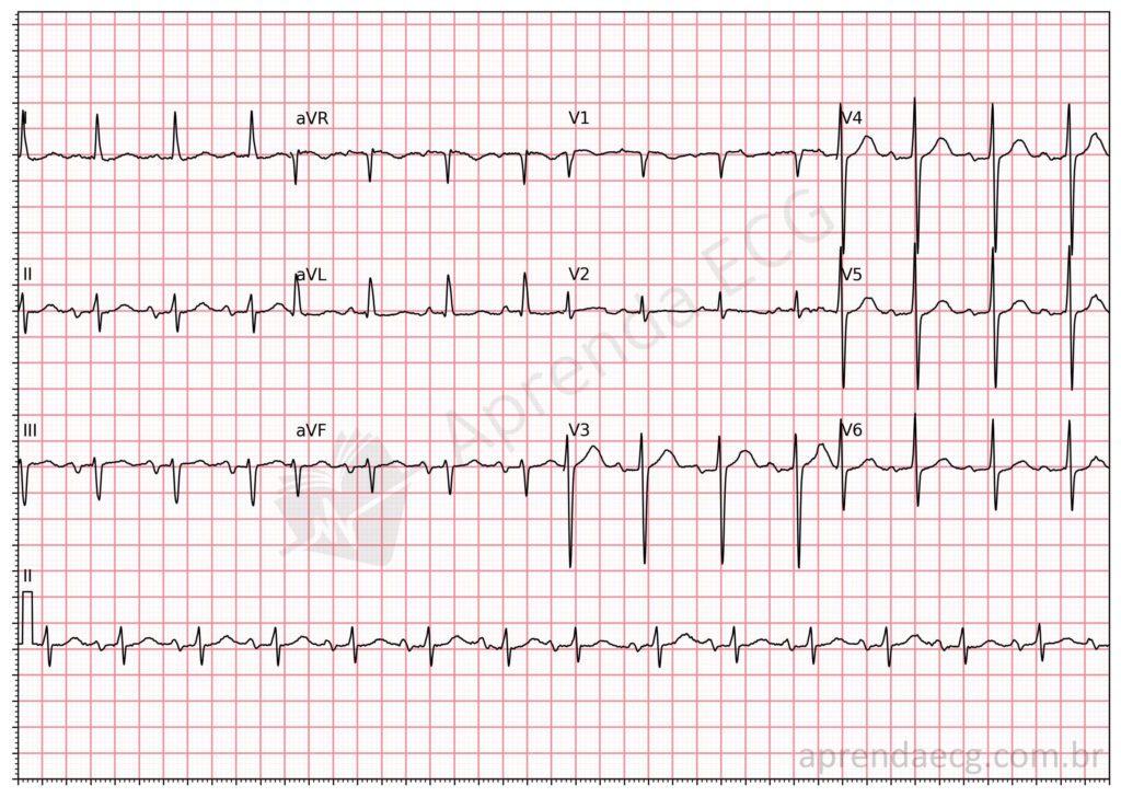 Electrocardiogram showing advanced interatrial block