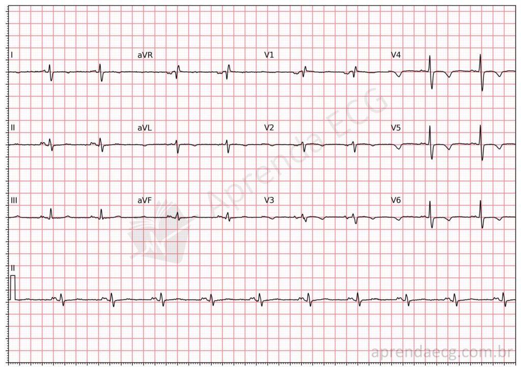 Electrocardiogram showing partial interatrial block