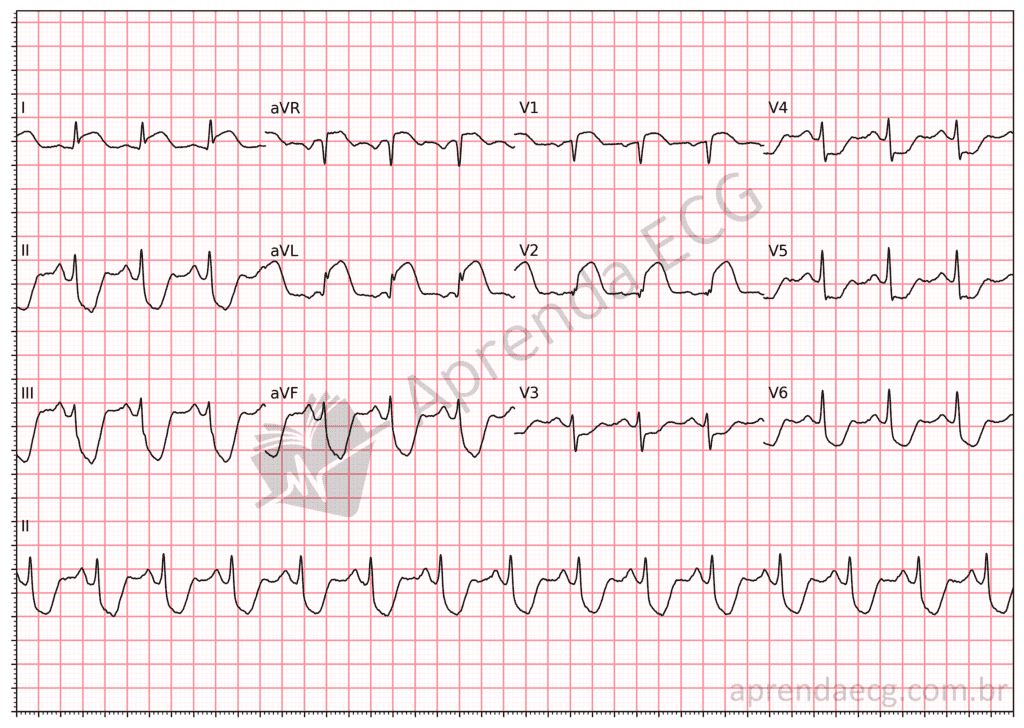 Electrocardiogram with ST elevation in I, aVL and V2 and inferior ST depression