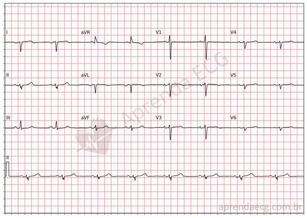 Electrocardiogram showing dextrocardia