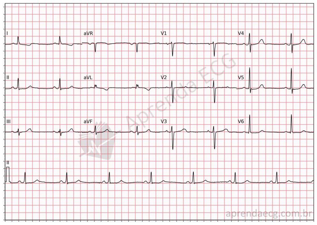 Electrocardiogram showing dextrocardia