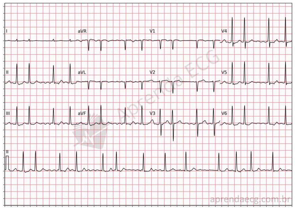 Electrocardiogram showing atrial fibrillation