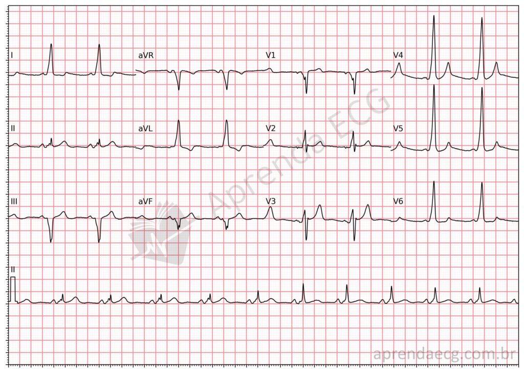 Electrocardiogram with ventricular pre-excitation and delta wave