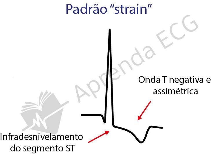 Representation of the left ventricular strain pattern