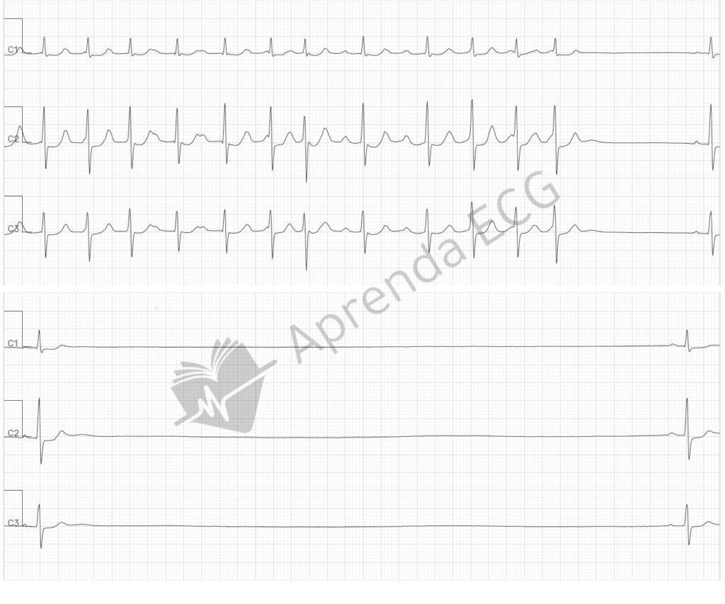 Bradycardia-tachycardia syndrome