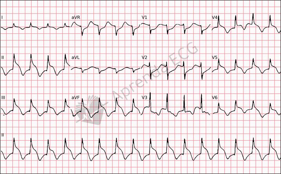 Electrocardiogram showing the spiked helmet sign