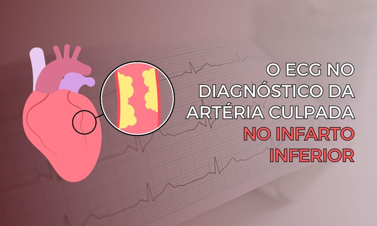 The electrocardiogram in the differential diagnosis of the culprit artery in inferior myocardial infarction