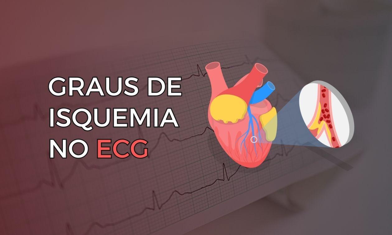 Grades of Ischemia on the Electrocardiogram