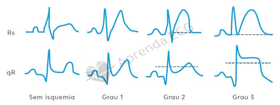 Grades of ischemia on the ECG