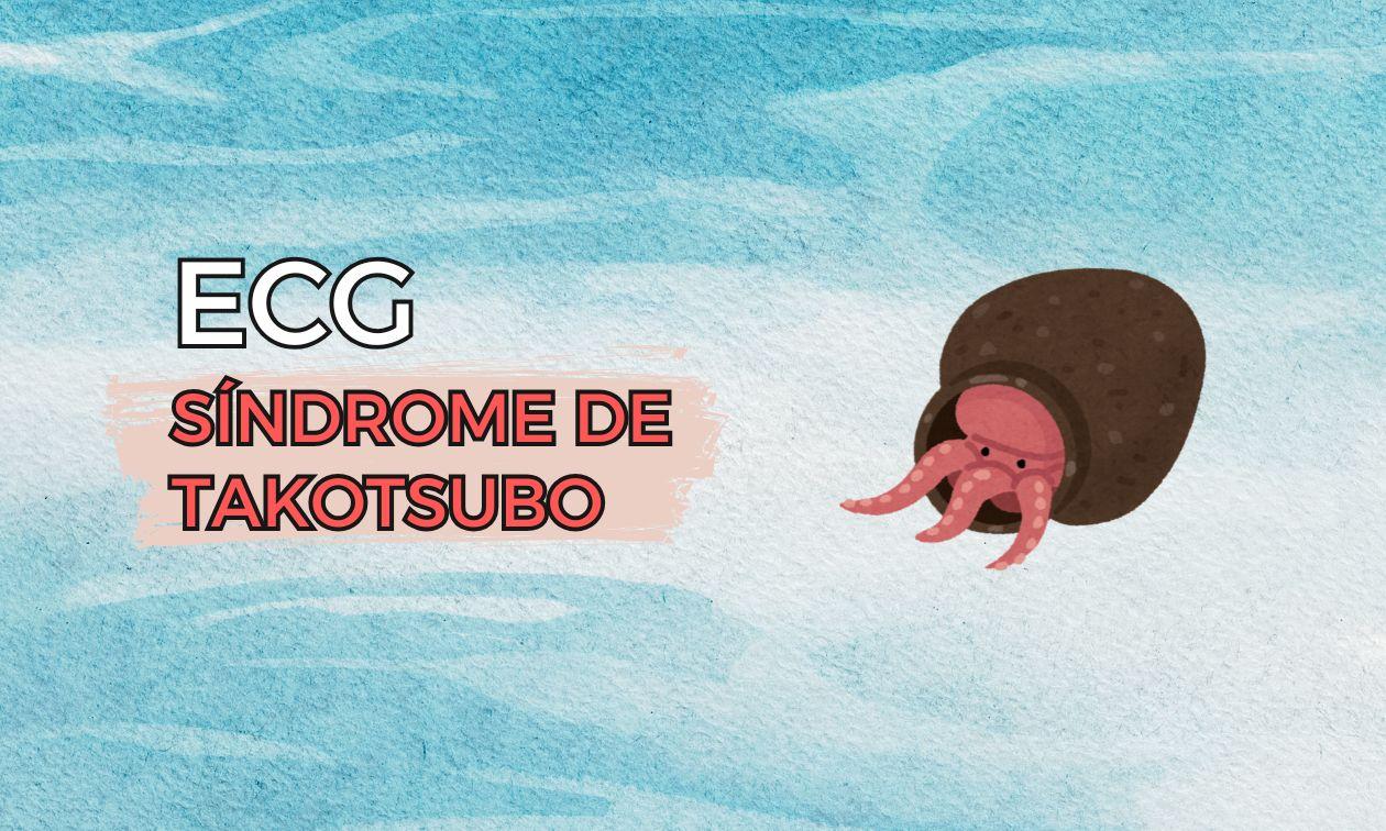ECG en el síndrome de Takotsubo