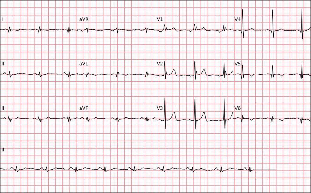 ECG | Zona eléctricamente inactiva lateral