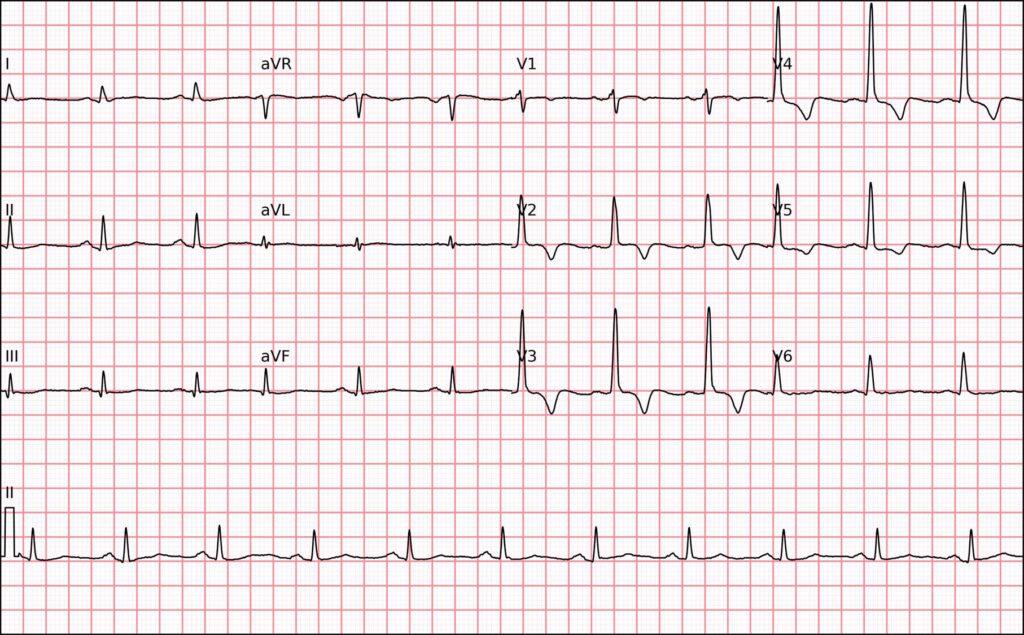 ECG | Bloqueo fascicular septal izquierdo (BFSI)