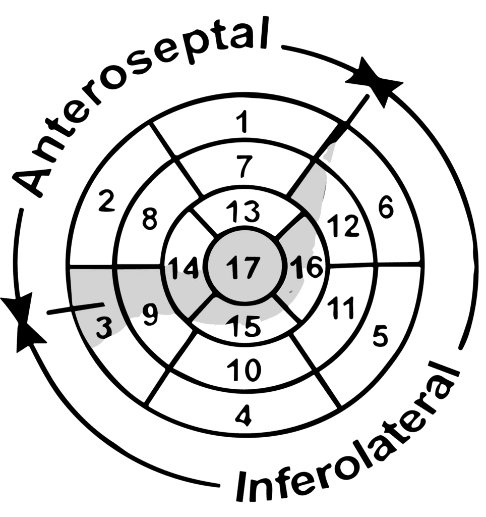Polar map of the 17 left ventricular segments divided into the anteroseptal and inferolateral regions