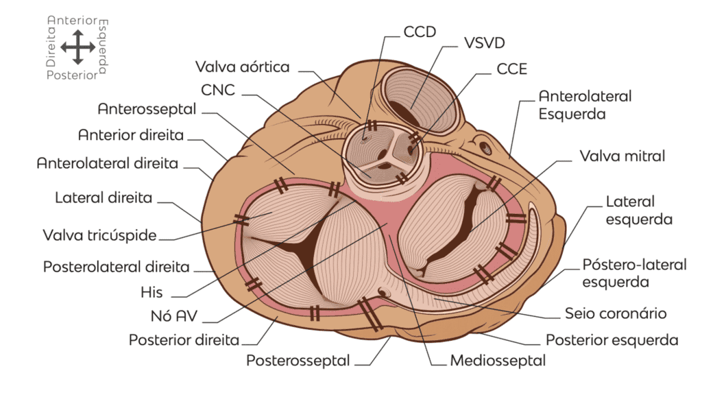 Atrioventricular ring viewed from above, showing possible accessory pathway locations around the mitral and tricuspid valves