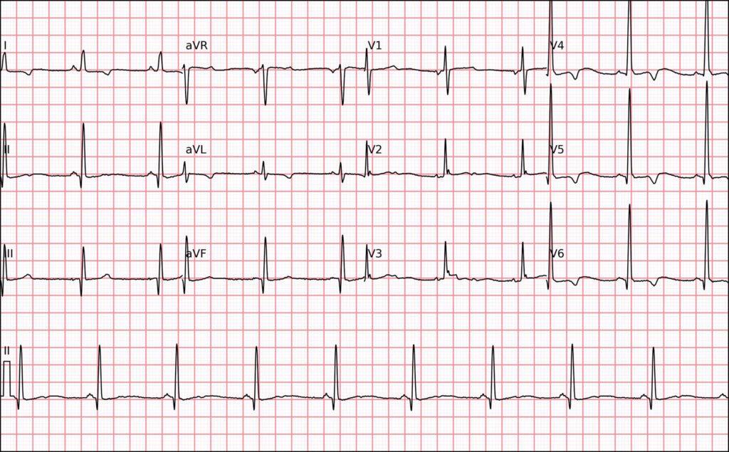 ECG de 12 derivaciones en la miocardiopatía hipertrófica con ondas R prominentes en V1–V3 e inversión de la onda T en V4–V6