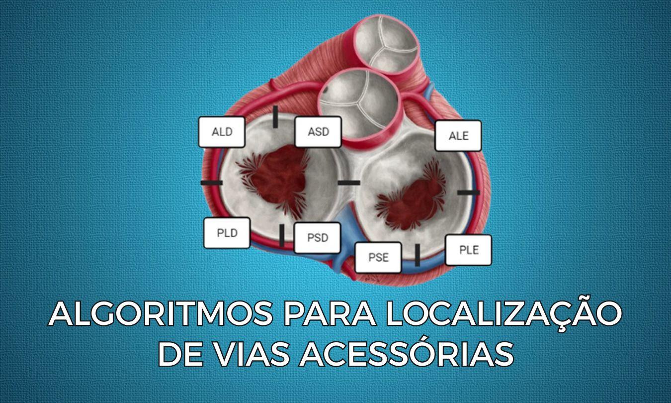 Accessory Pathway Localization Algorithms: Understand, Compare, and Meet the EPM
