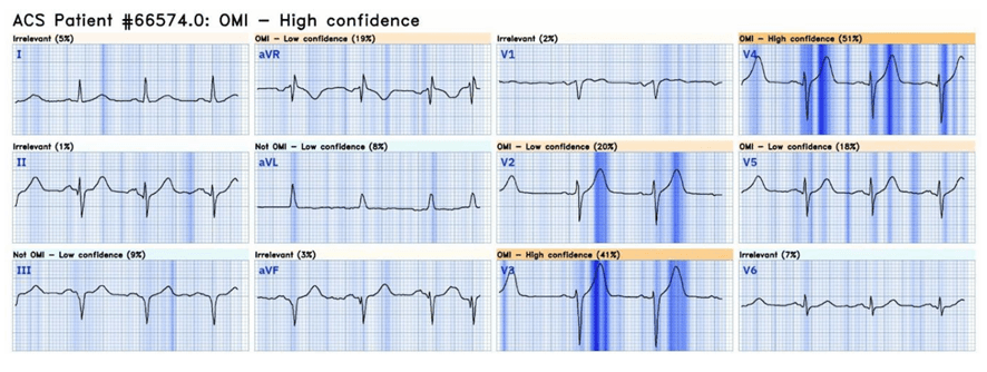 Se muestran ondas T hiperagudas en las derivaciones V2–V4, destacadas por la IA Queen of Hearts mediante un mapa de prominencia con sombreado vertical más oscuro. Fuente: artículo citado. Este paciente tenía OCA y no fue diagnosticado porque no presentaba elevación del ST.