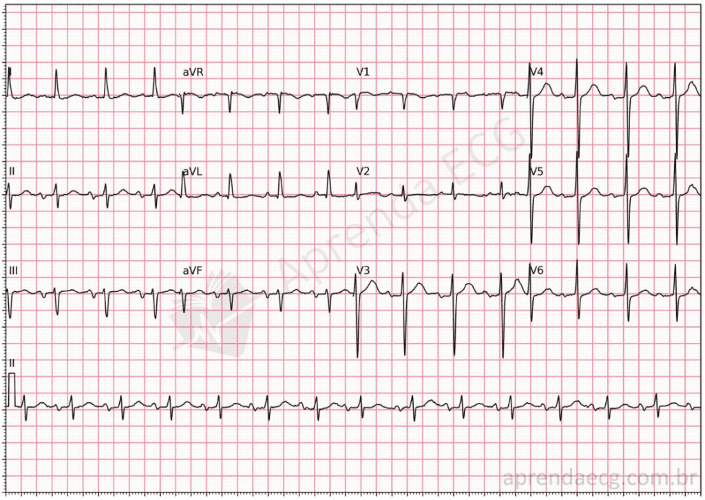 12-lead ECG with advanced interatrial block and a biphasic (plus-minus) P wave in II, III and aVF