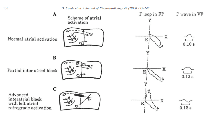 Diagram by Conde et al. of atrial activation, P loop and P wave in aVF in normal conduction, partial IAB and advanced IAB