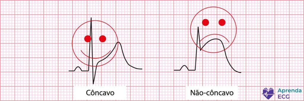 Supradesnivel del ST cóncavo (cara sonriente) frente a no cóncavo (cara triste): el mito del supradesnivel feliz