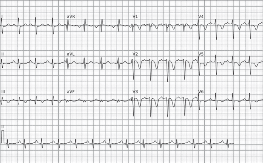 ECG con signos clásicamente asociados a la TEP. Note la inversión de las ondas T en las caras anterior e inferior, la taquicardia sinusal y el patrón S1Q3T3.