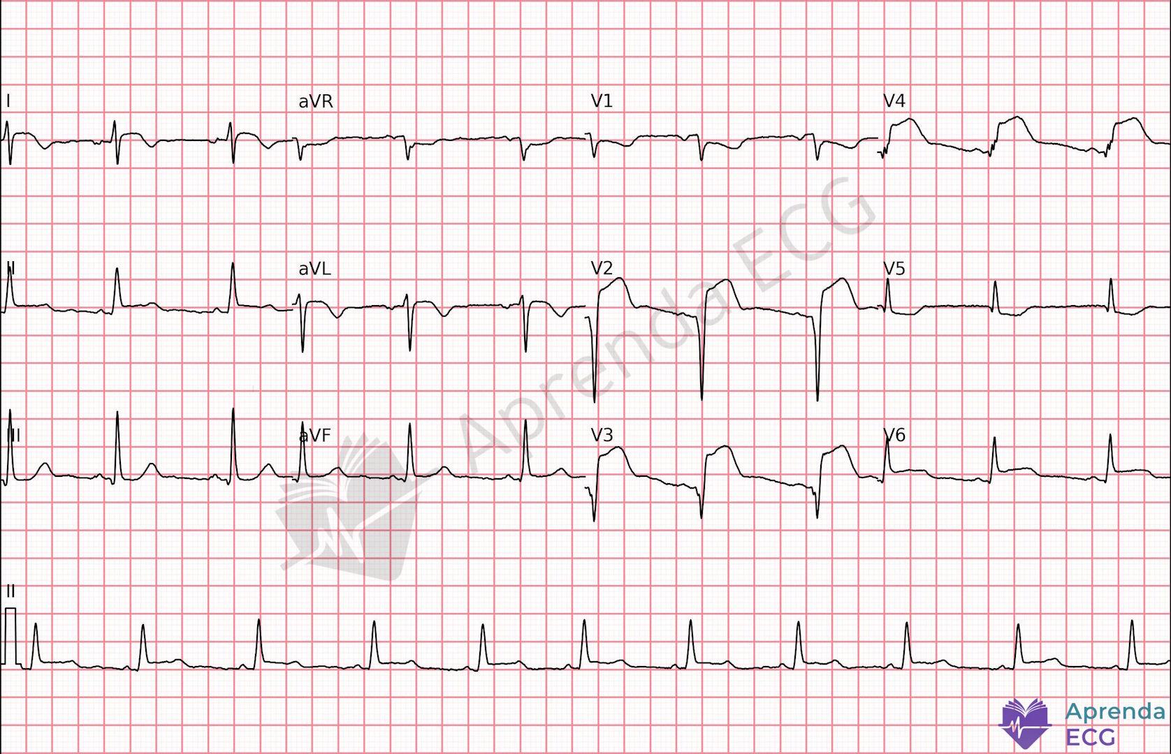 ECG with ST-segment elevation in the extensive anterior wall consistent with acute myocardial infarction