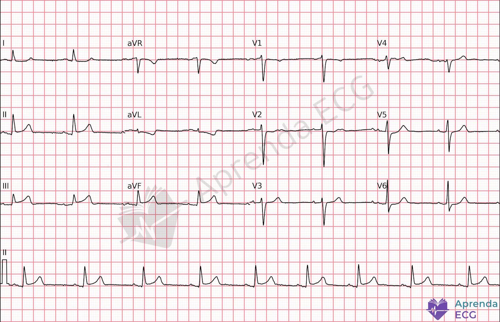 ECG with subtle ST-segment elevation suggestive of acute myocardial infarction