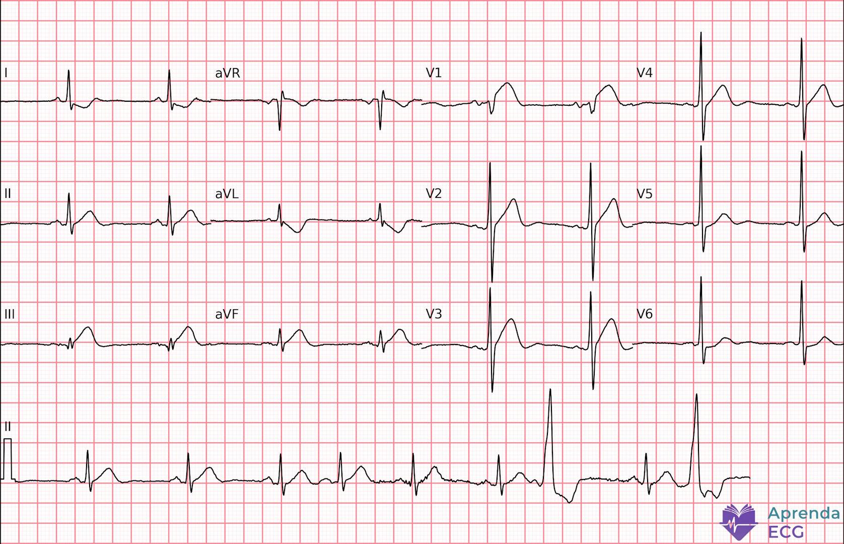 ECG with hyperacute T wave suggestive of early-phase acute myocardial infarction