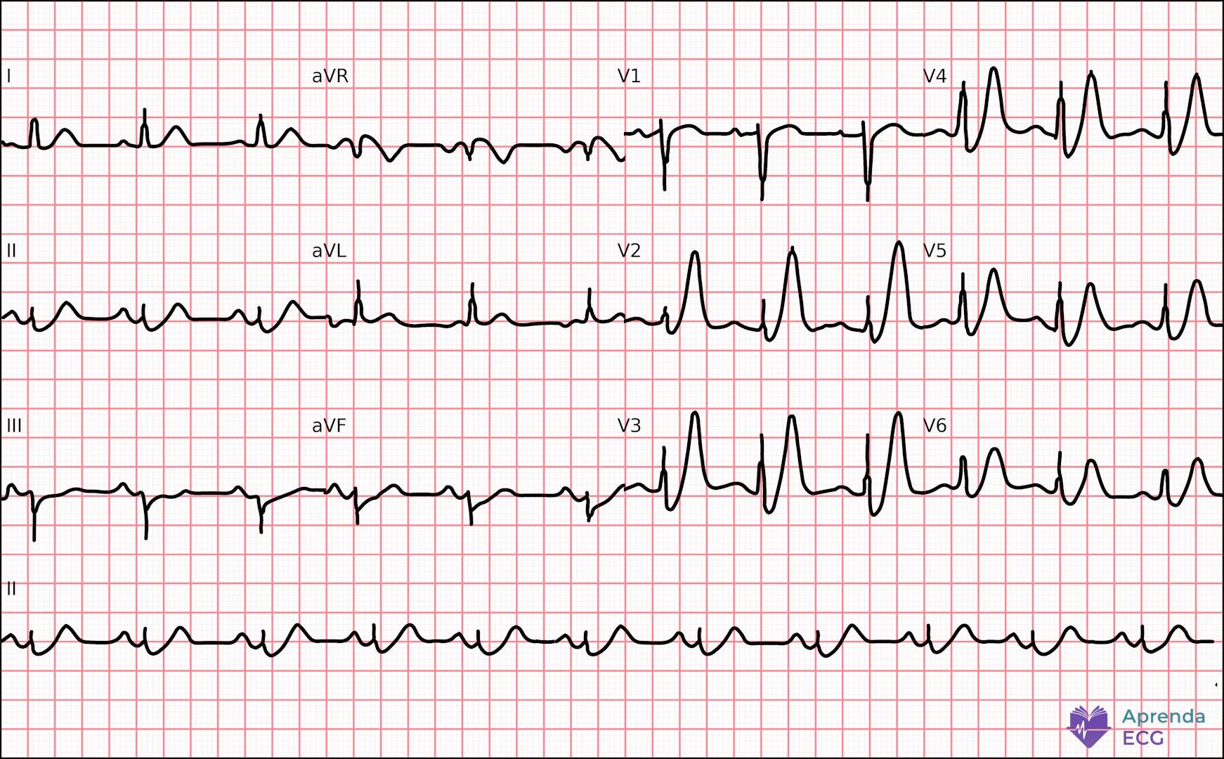 ECG with De Winter pattern characterized by precordial ST depression and tall symmetric T waves
