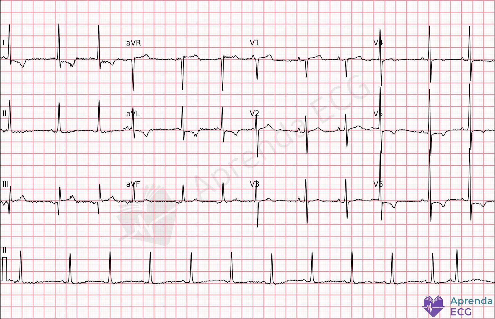 ECG with Aslanger pattern