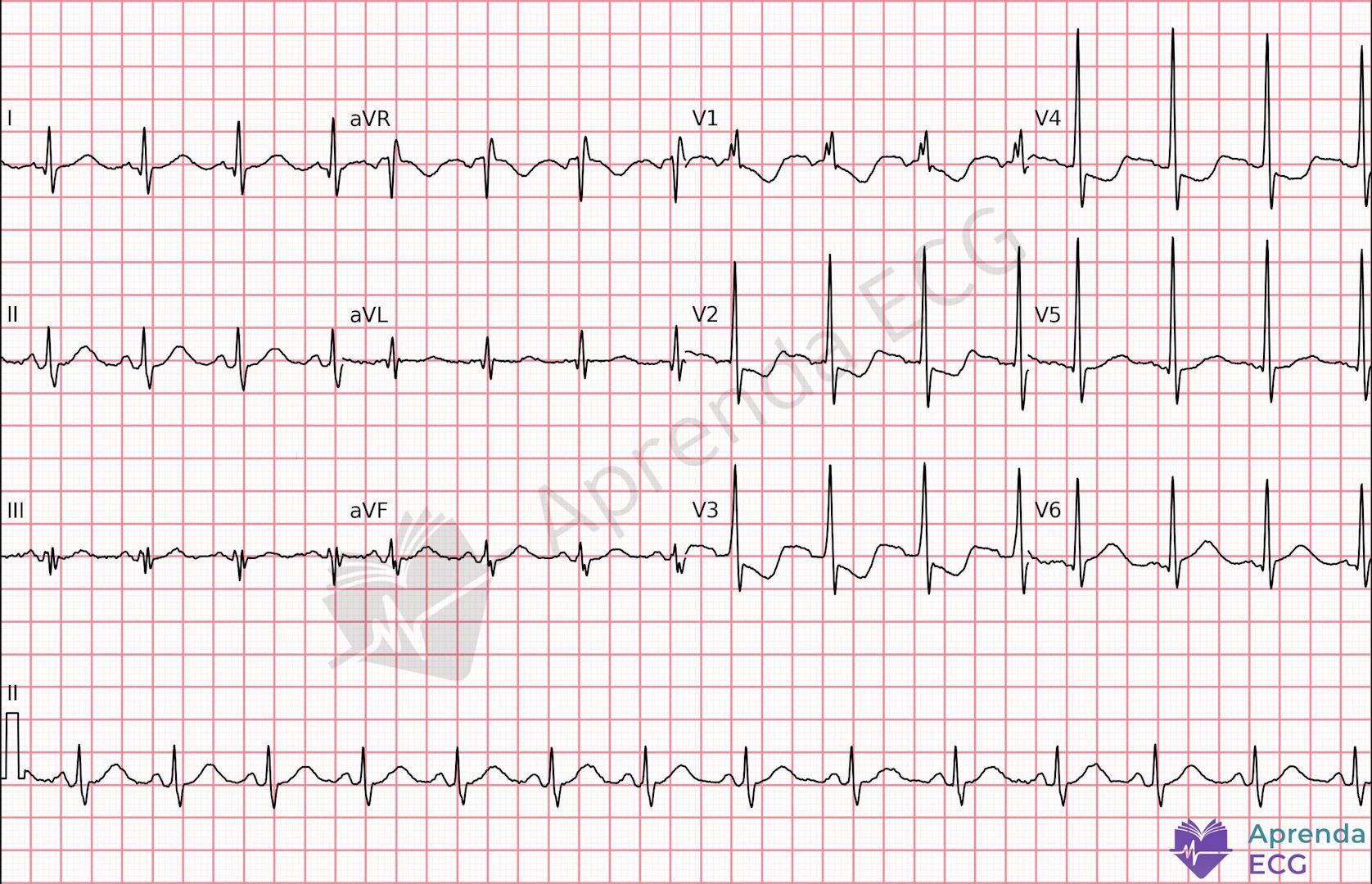 ECG with ST-segment depression from V1 to V3 suggestive of lateral infarction