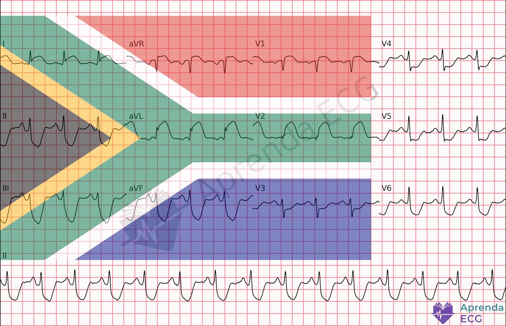 ECG with the pattern known as the South African flag sign indicating occlusion of the first diagonal branch