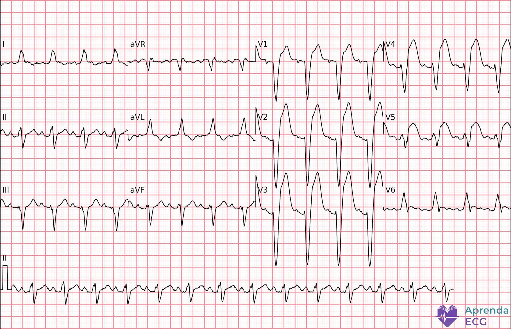 ECG with left bundle branch block and a modified Sgarbossa criterion suggestive of acute myocardial infarction