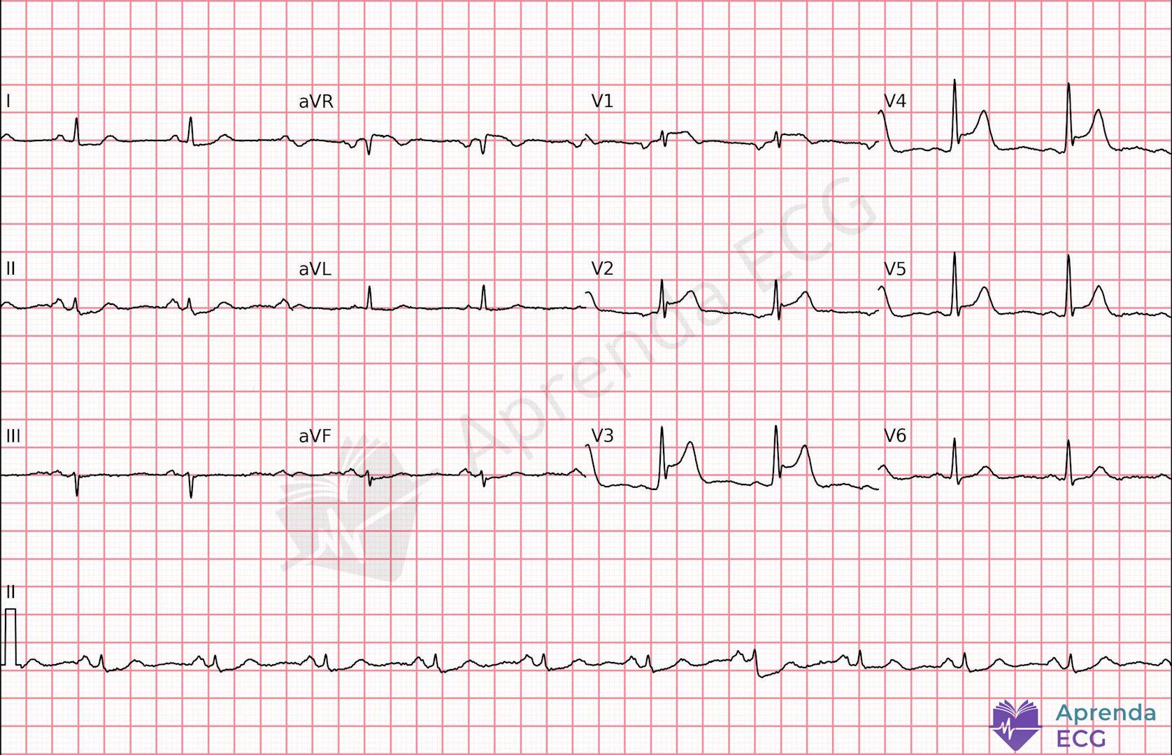 ECG with terminal QRS distortion in the precordial leads suggestive of acute anterior infarction