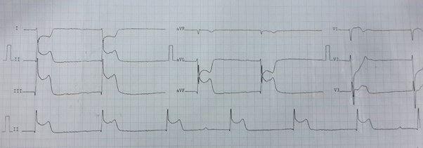 ECG showing the Dead Man Sign, characterized by specific ST-segment changes