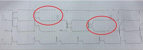 Annotated ECG highlighting the Dead Man Sign and its characteristic electrocardiographic changes