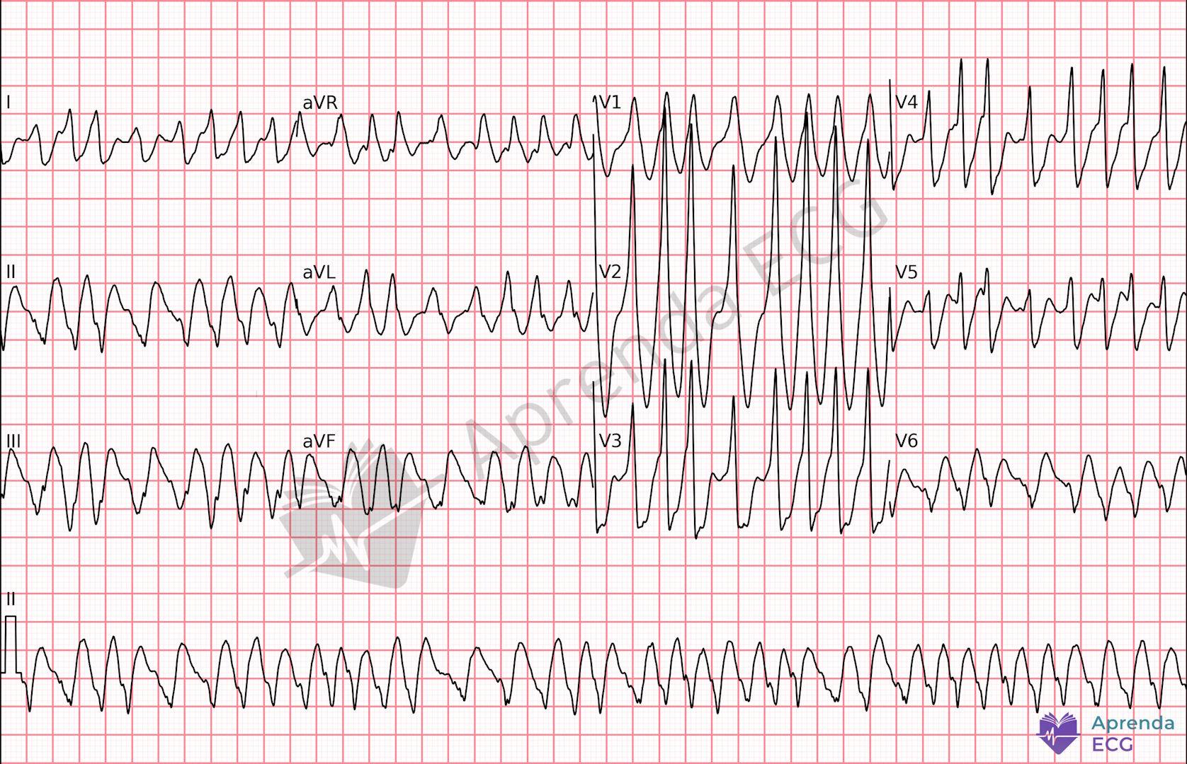 ECG with pre-excited atrial fibrillation showing an irregular wide-QRS rhythm and conduction over an accessory pathway